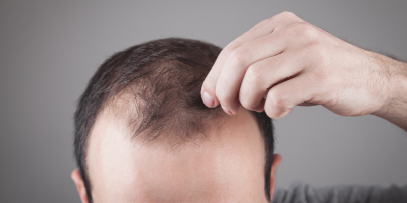 ریزش مو چیست