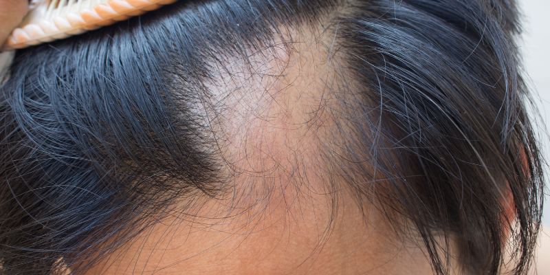 ریزش مو چیست