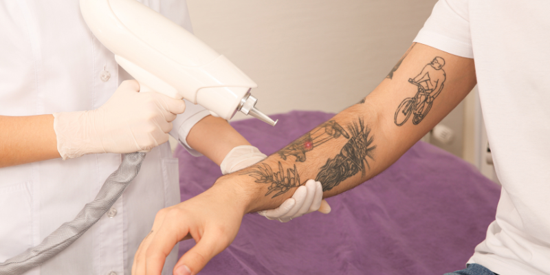 از بین بردن تتو