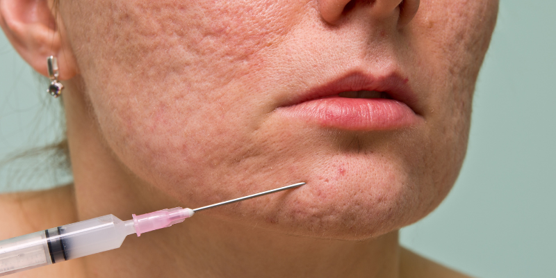 درمان جوش های زیر پوستی