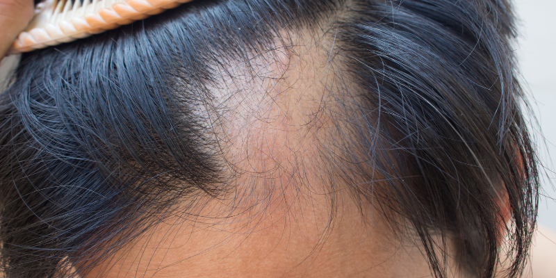 علت ریزش مو و درمان آن