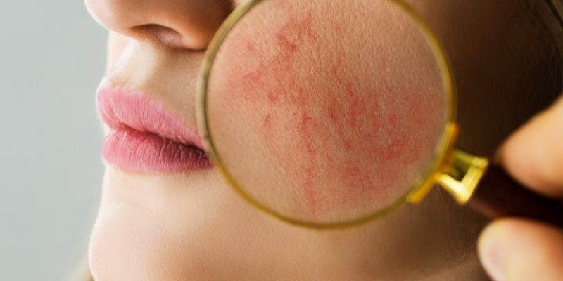 دانه های قرمز روی پوست