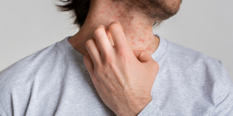 علت دانه های قرمز روی پوست