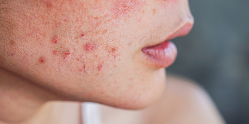 علت دانه های قرمز روی پوست