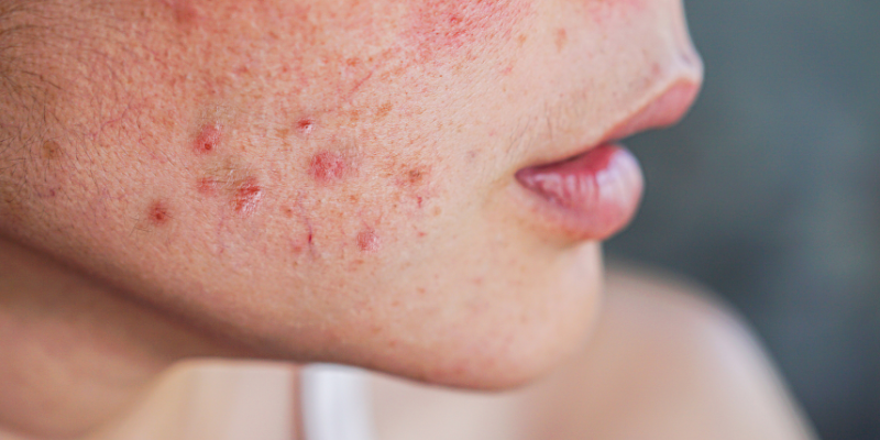 آکنه های هورمونی