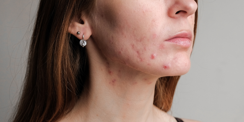 آکنه های هورمونی