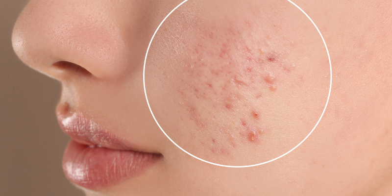 آکنه های هورمونی