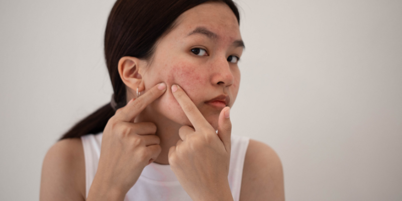 آکنه های هورمونی