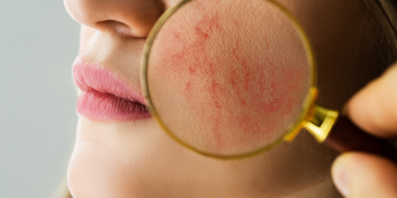 روزاسه چیست