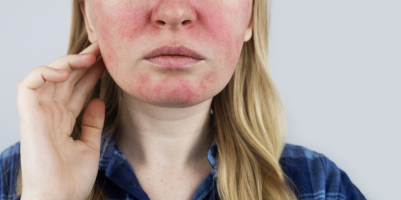 علت به وجود امدن روزاسه