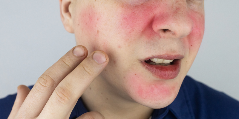 درمان روزاسه