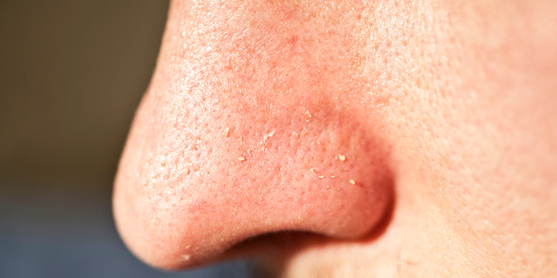 فشیال پوست چیست؟