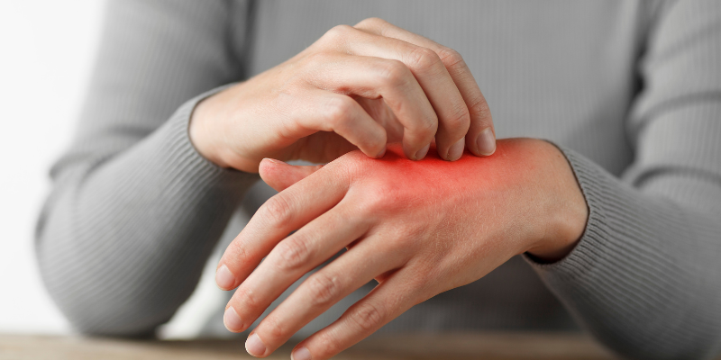 پسوریازیس های پوستی