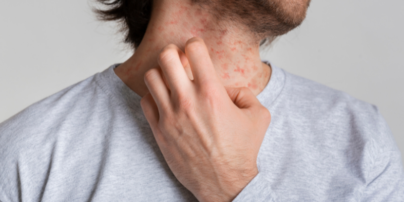 لک و پیس های پوستی