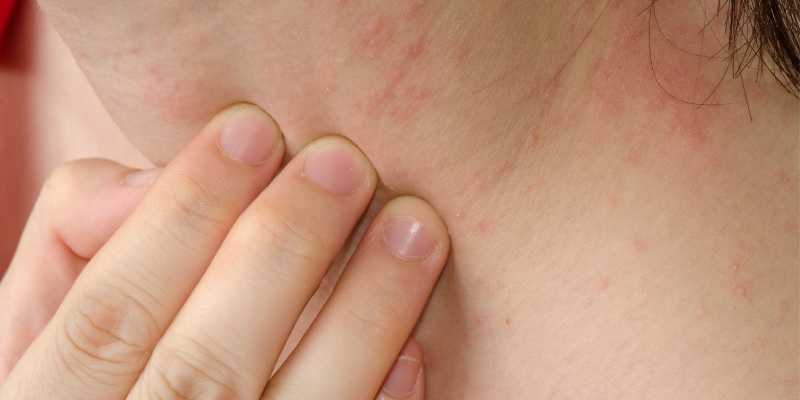 اگزما های پوستی