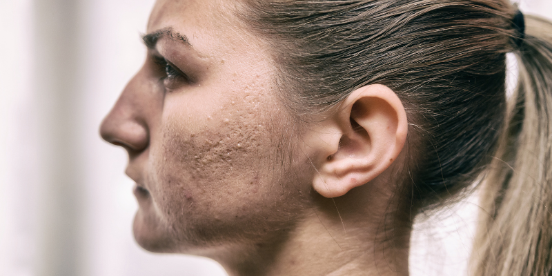 عواملی باعث بروز جوش های عصبی