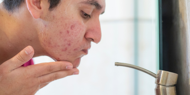 چرا آکنه های عصبی با درد همراه هستند؟