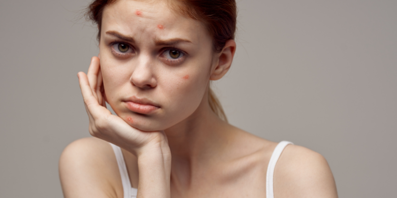 آکنه های پوستی