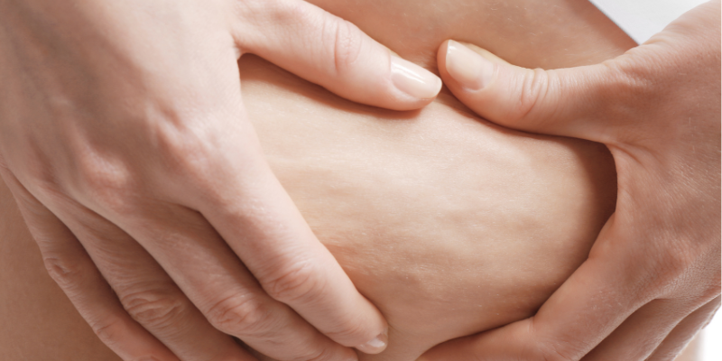 علت بوجود آمدن سلولیت