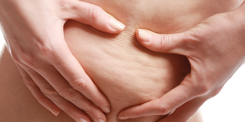 روش های خانگی برای درمان سلولیت