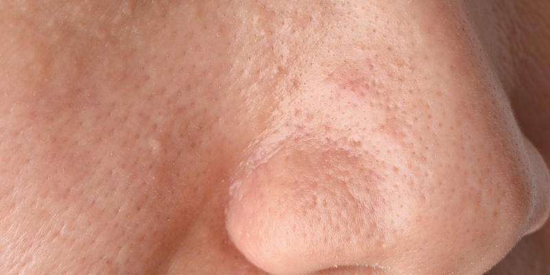 مراقبت از پوست چرب