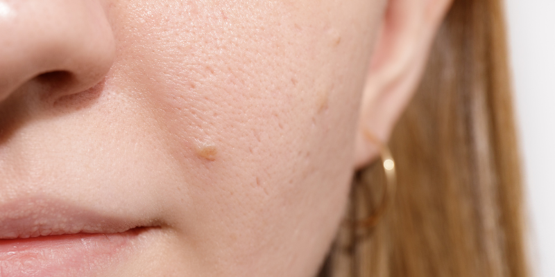 مشخصات پوست چرب