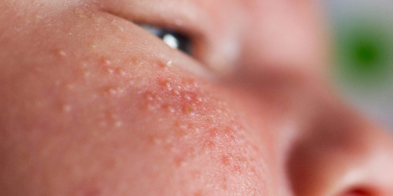 پیشگیری از میلیا