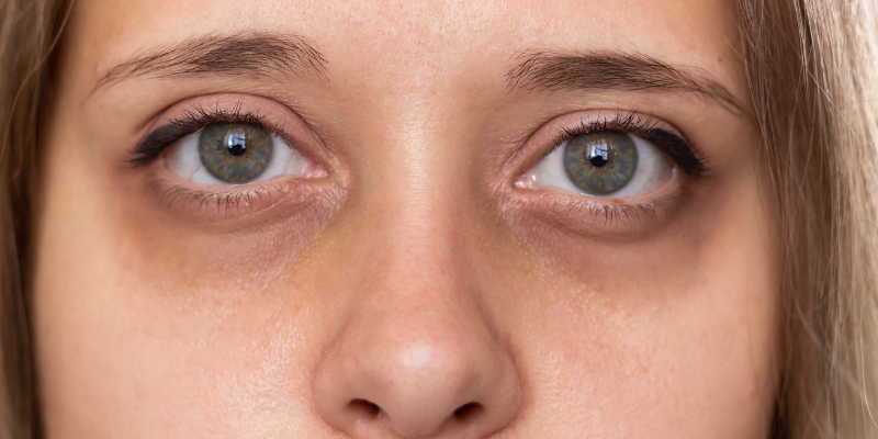 علت بوجود آمدن لکه های زیر چشم