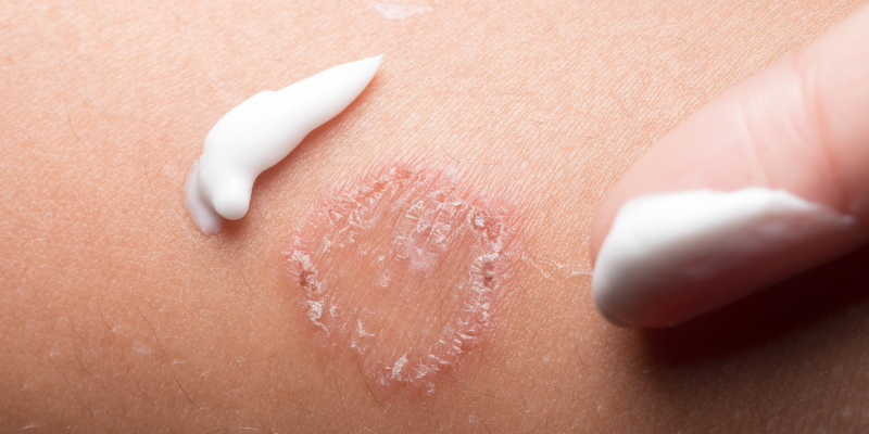سلولیت و عفونت پوستی چگونه ایجاد می شود؟