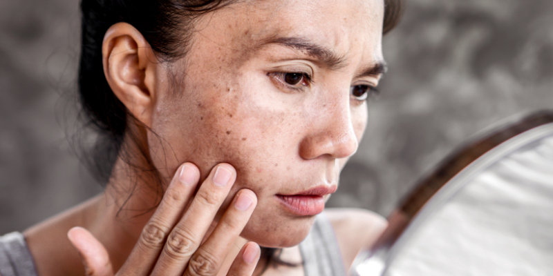 لکه های پوستی در دوران بارداری