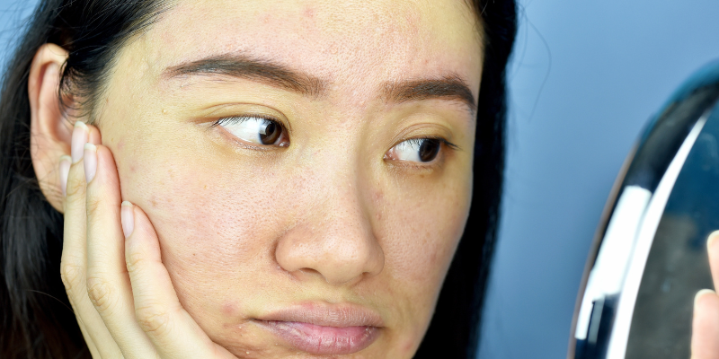 لکه های پوستی در دوران بارداری