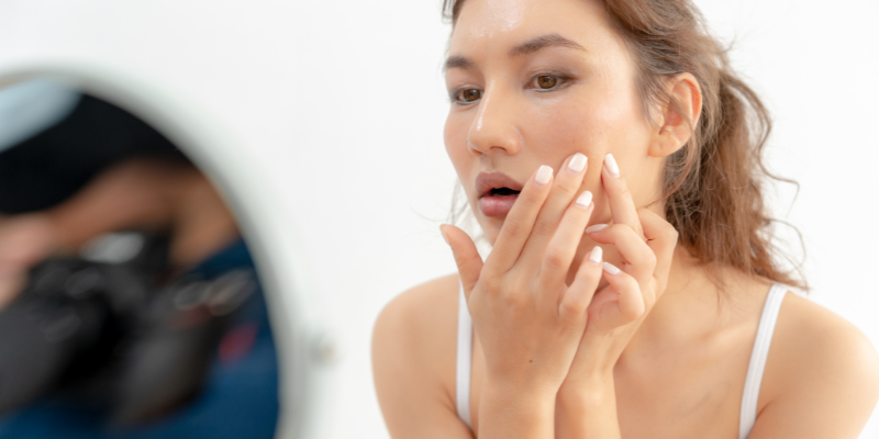 آکنه روزاسه