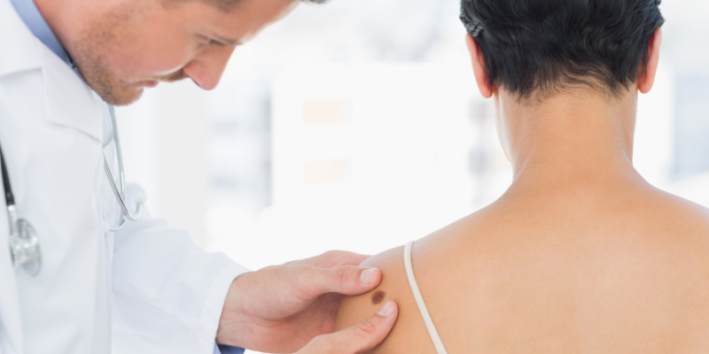 ملانوما در بیماری های پوستی