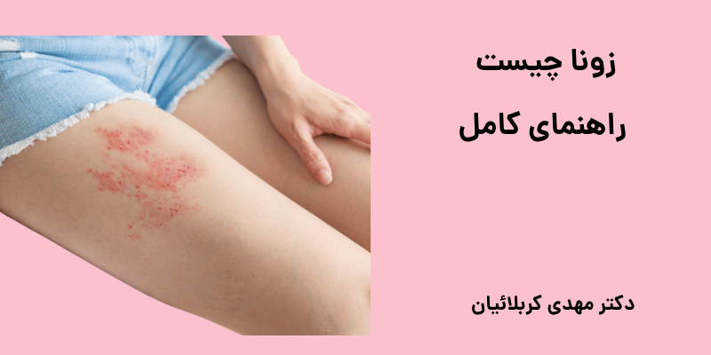 زونا