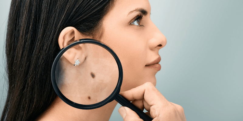 خال گوشتی چیست؟