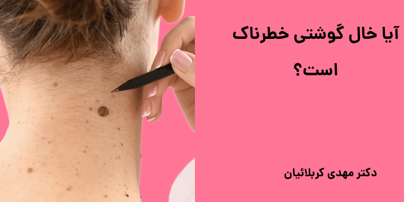خال گوشتی