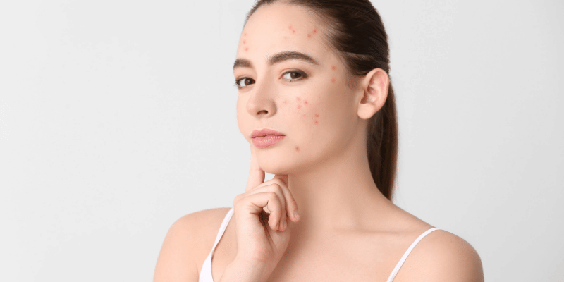 روش‌های پیشگیری از جوش زیرپوستی