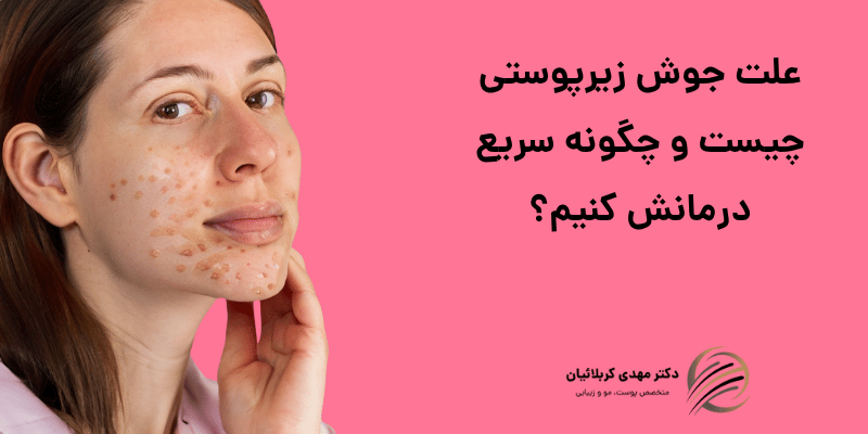 علت جوش زیرپوستی چیست