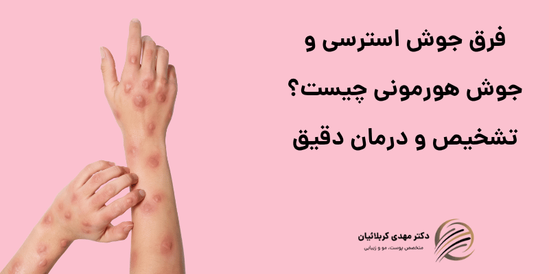 فرق جوش استرسی و جوش هورمونی