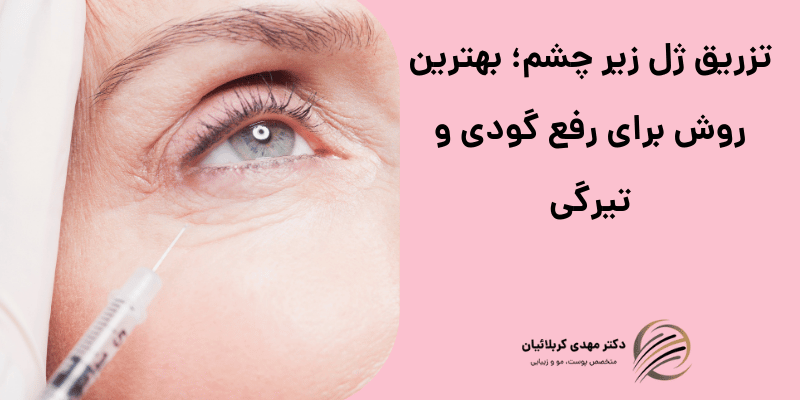 تزریق ژل زیر چشم
