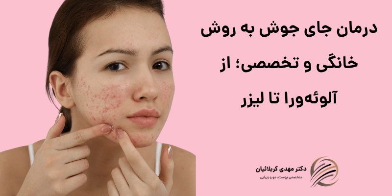 درمان جای جوش به روش خانگی
