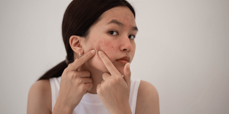 دلایل ایجاد جای جوش
