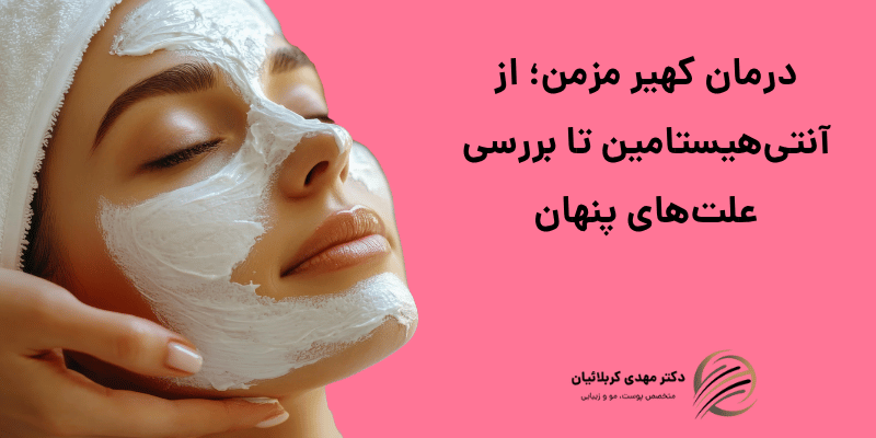 درمان کهیر مزمن