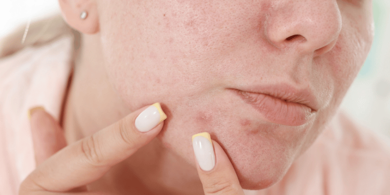 چرا جوش بعد از اصلاح صورت ایجاد می‌شود