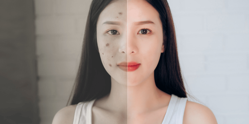 آکنه در مردان یا زنان شایع‌تر است؟