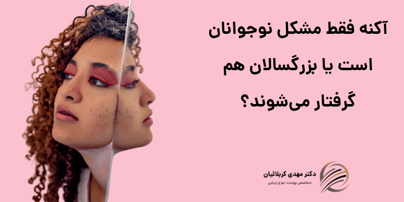 آکنه فقط مشکل نوجوانان است یا بزرگسالان هم گرفتار می‌شوند