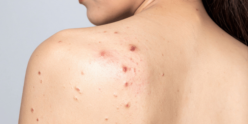 جوش‌ها مزمن یا التهابی