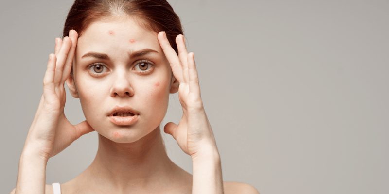 درمان آکنه بزرگسالان