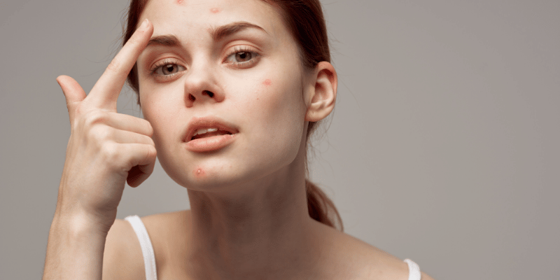 چرا بزرگسالان دچار آکنه می‌شوند؟