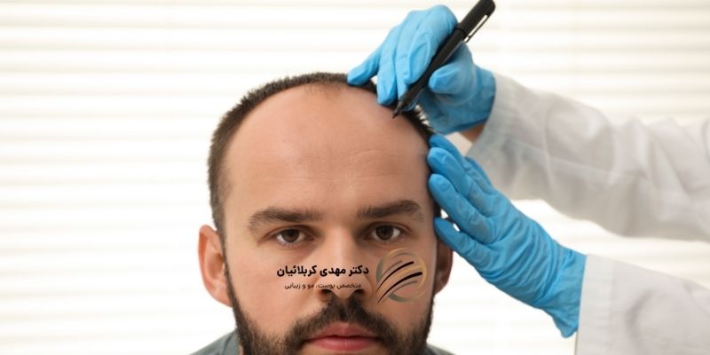 روش کاشت مو با میکروایمپلنت